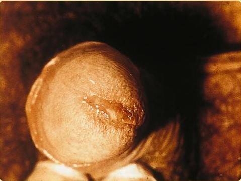 chlamydia-męższczyzny