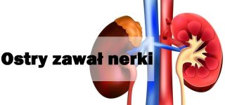 Ostry zawał nerki – Patogeneza i migotanie przedsionków