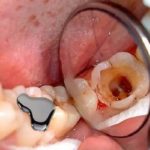 Europejskie organizacje pozarządowe przeciw rtęci stosowanej przez dentystów