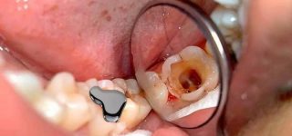 Europejskie organizacje pozarządowe przeciw rtęci stosowanej przez dentystów