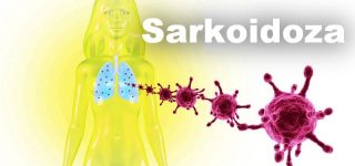 Sarkoidoza choroba układu odpornościowego