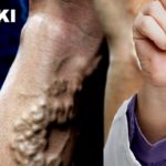 Flebologia diagnostyka i choroba żył. Przewlekła choroba żylna, żylaki – standardy i procedury medyczne