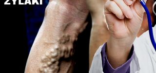 Flebologia diagnostyka i choroba żył. Przewlekła choroba żylna, żylaki – standardy i procedury medyczne
