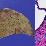 Zgorzel gazowa niezwiązana z Clostridium