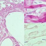Martwicze zapalenie jelit wywołane przez Clostridium butyricum